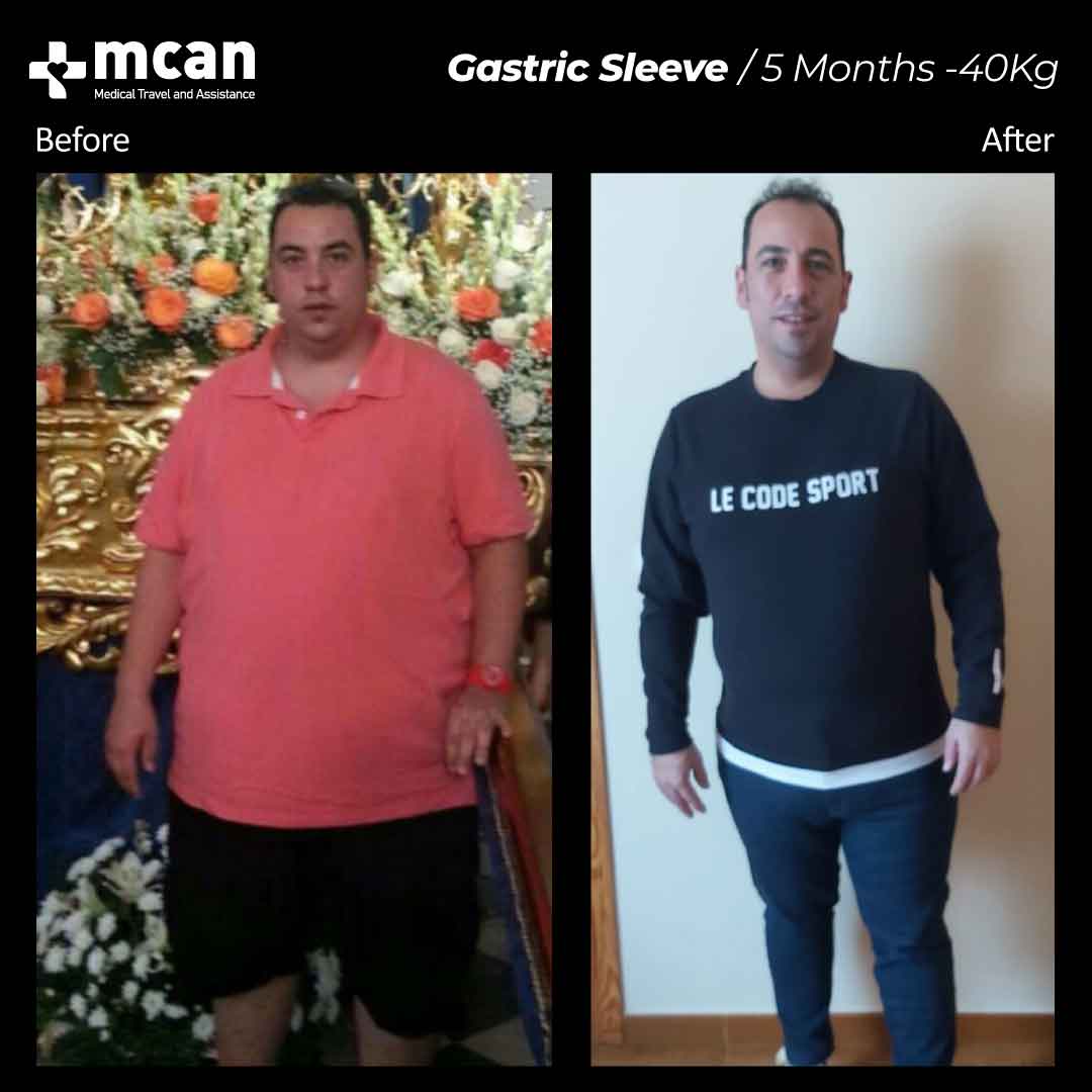 Gastric Sleeve Turkey Before After MCAN Health 02042102