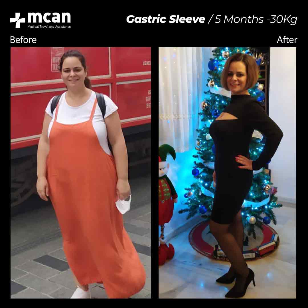 Gastric Sleeve Turkey Before After MCAN Health 02042103