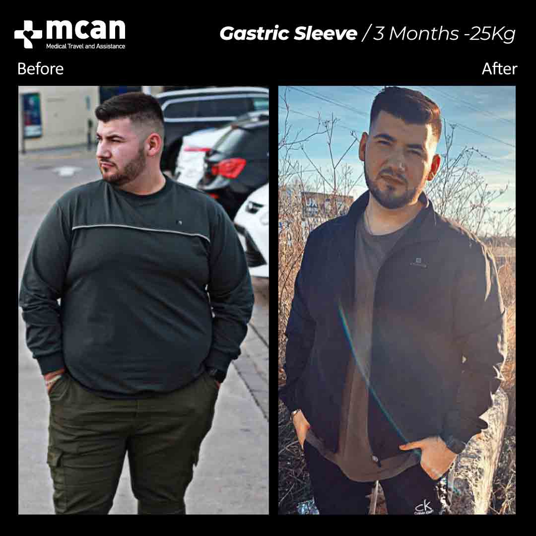Gastric Sleeve Turkey Before After MCAN Health 02042104