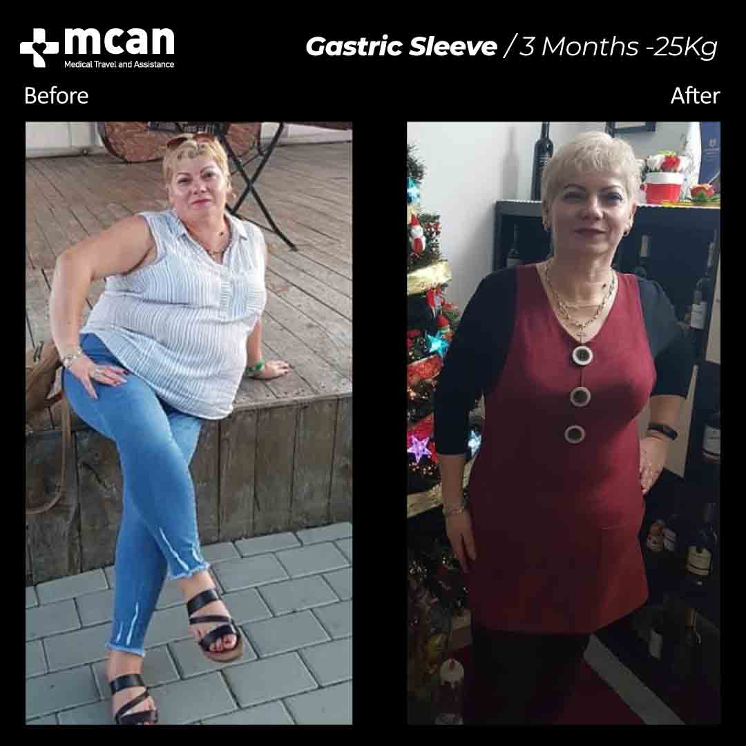 Gastric Sleeve Turkey Before After MCAN Health 02042106