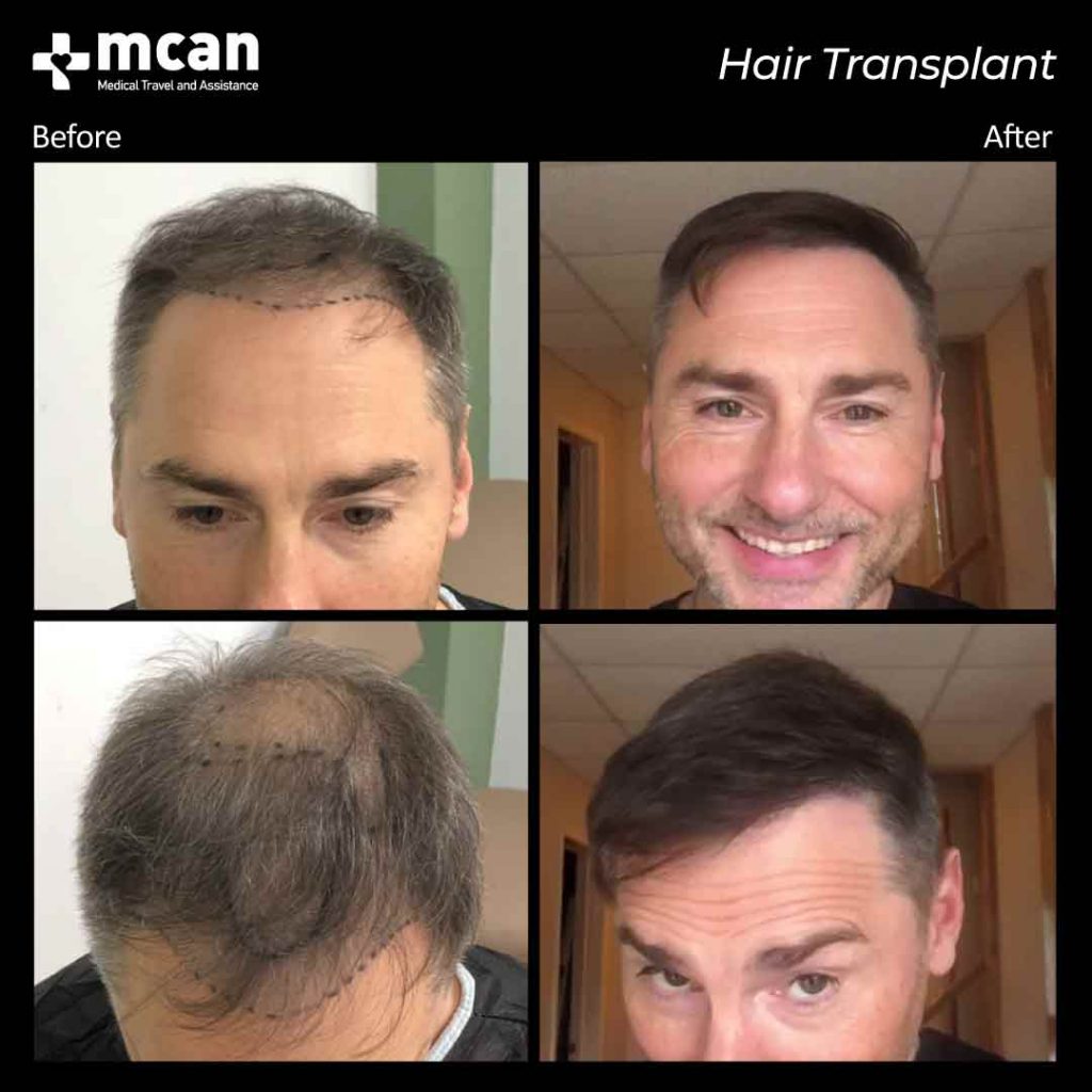 Hair Transplantation Before and After MCAN Health