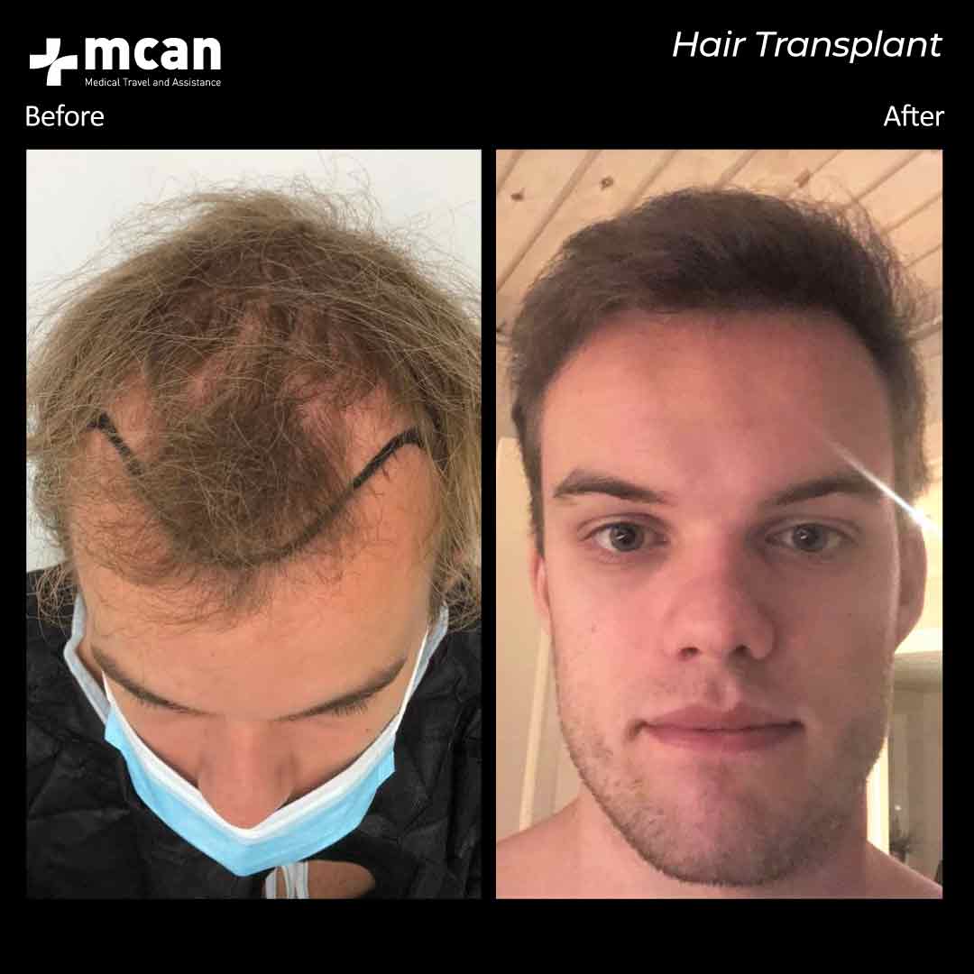 Hair Transplant Turkey Before After MCAN Health 020421