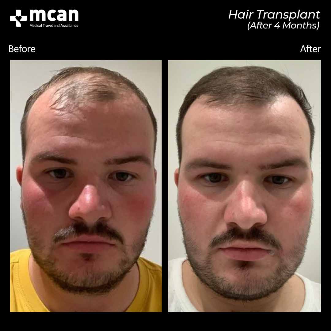 Hair Transplant Turkey Before After MCAN Health 02042102