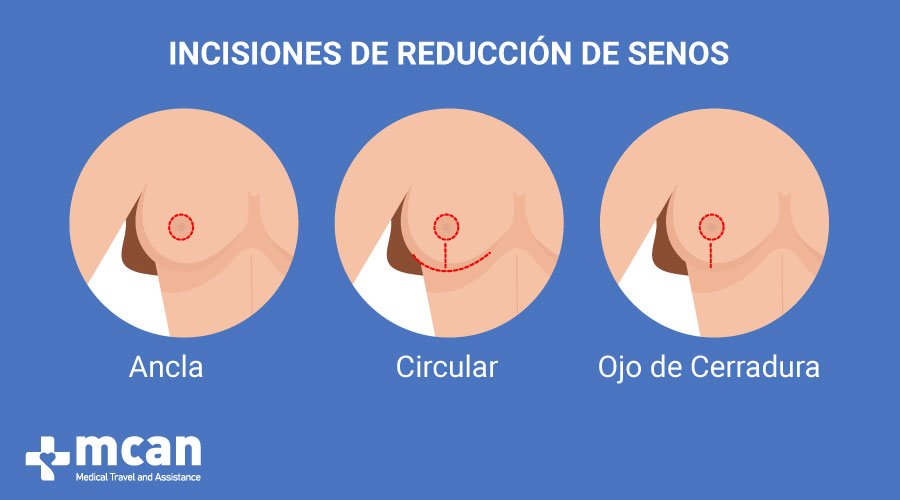 Incisiones-Reduccion de pecho en Turquia MCAN Health