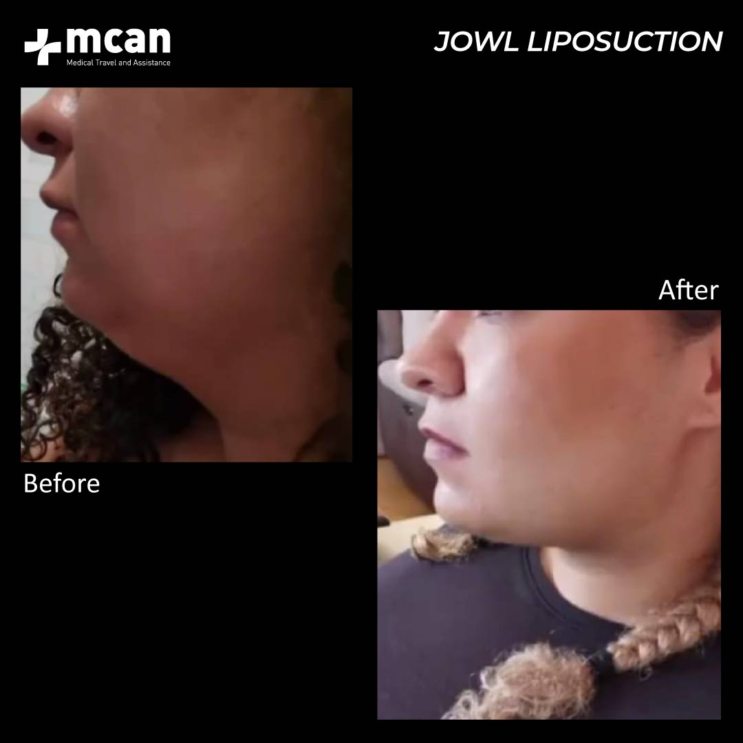 Jowl Liposuction Before After 010601