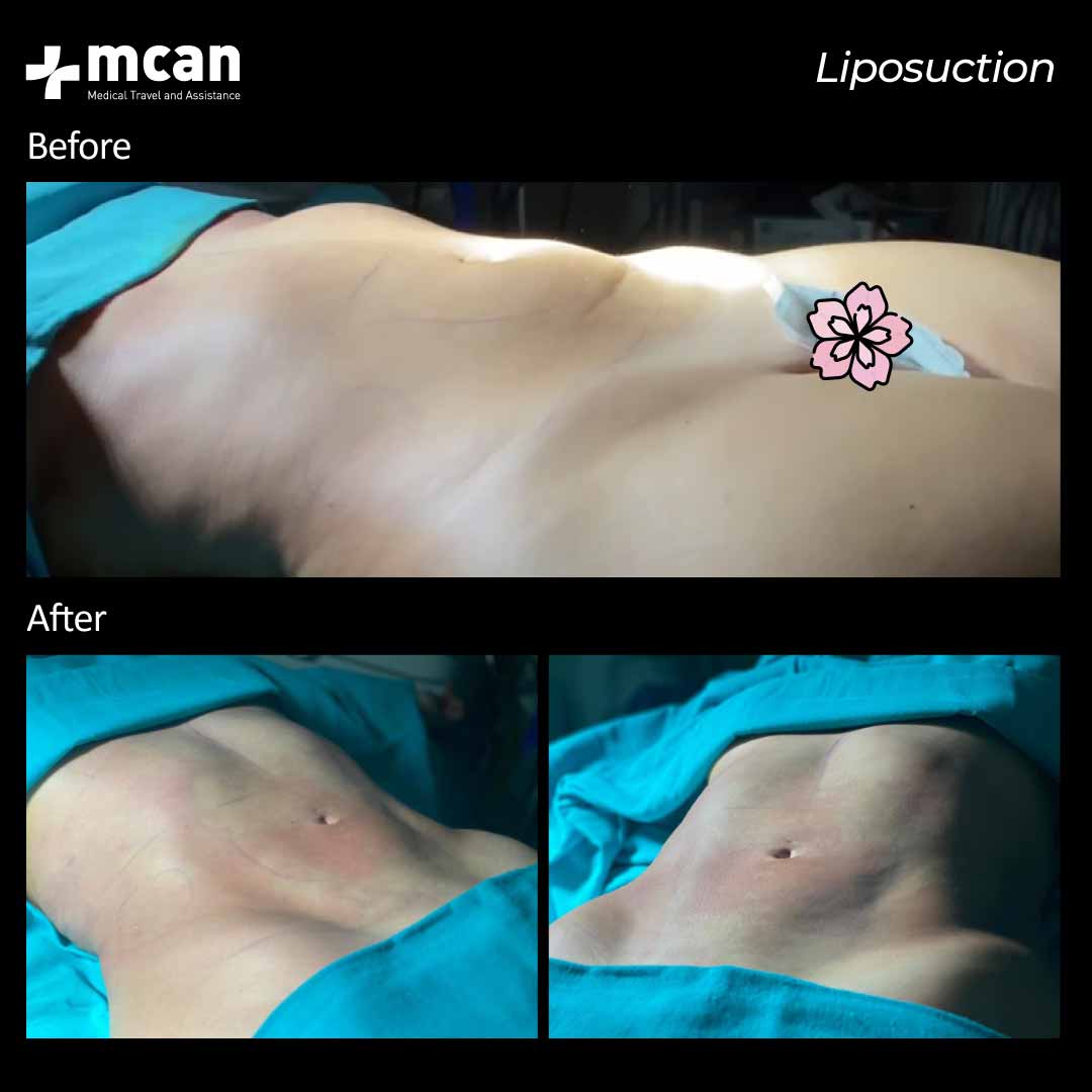Liposuction Before After 040101
