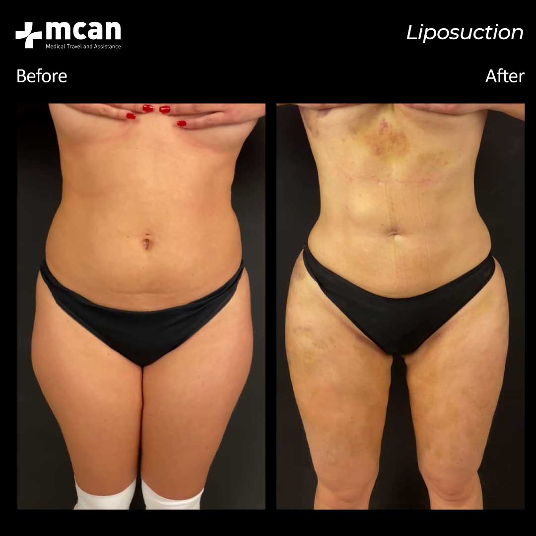 Liposuction Turkey Before After MCAN Health 02042101