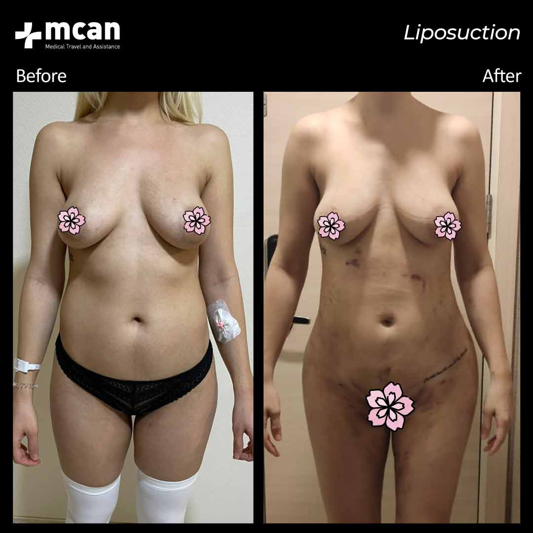 Liposuction Turkey Before After MCAN Health 02042102