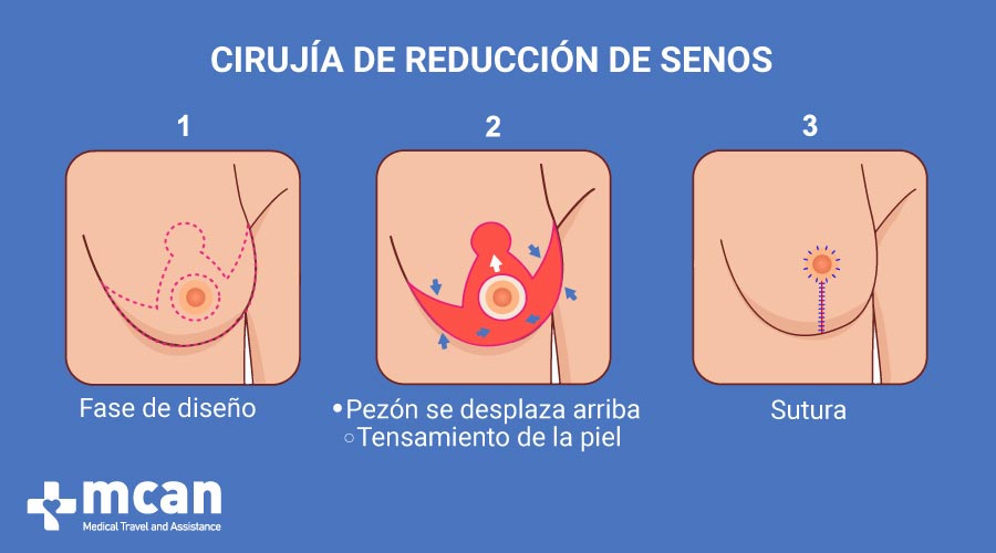 Reposición de los pezones y eliminación del tejido sobrante MCAN Health Reduccion de pecho en Turquia