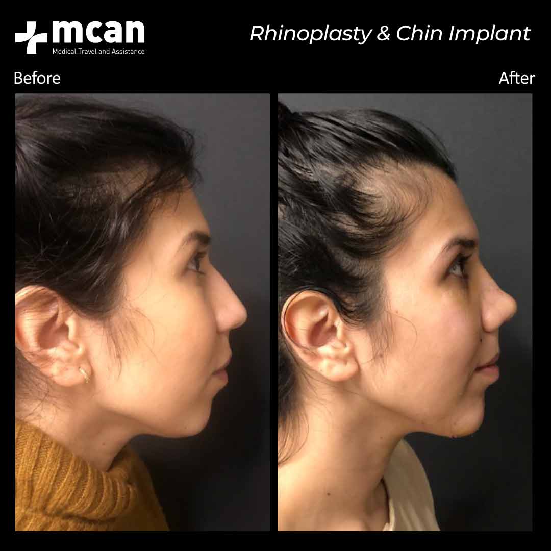 Rhinoplasty Chin Implant Before After 010601