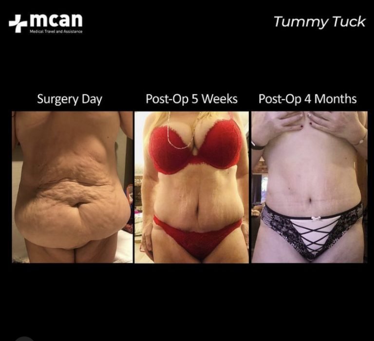 Sarah tummy tuck before after