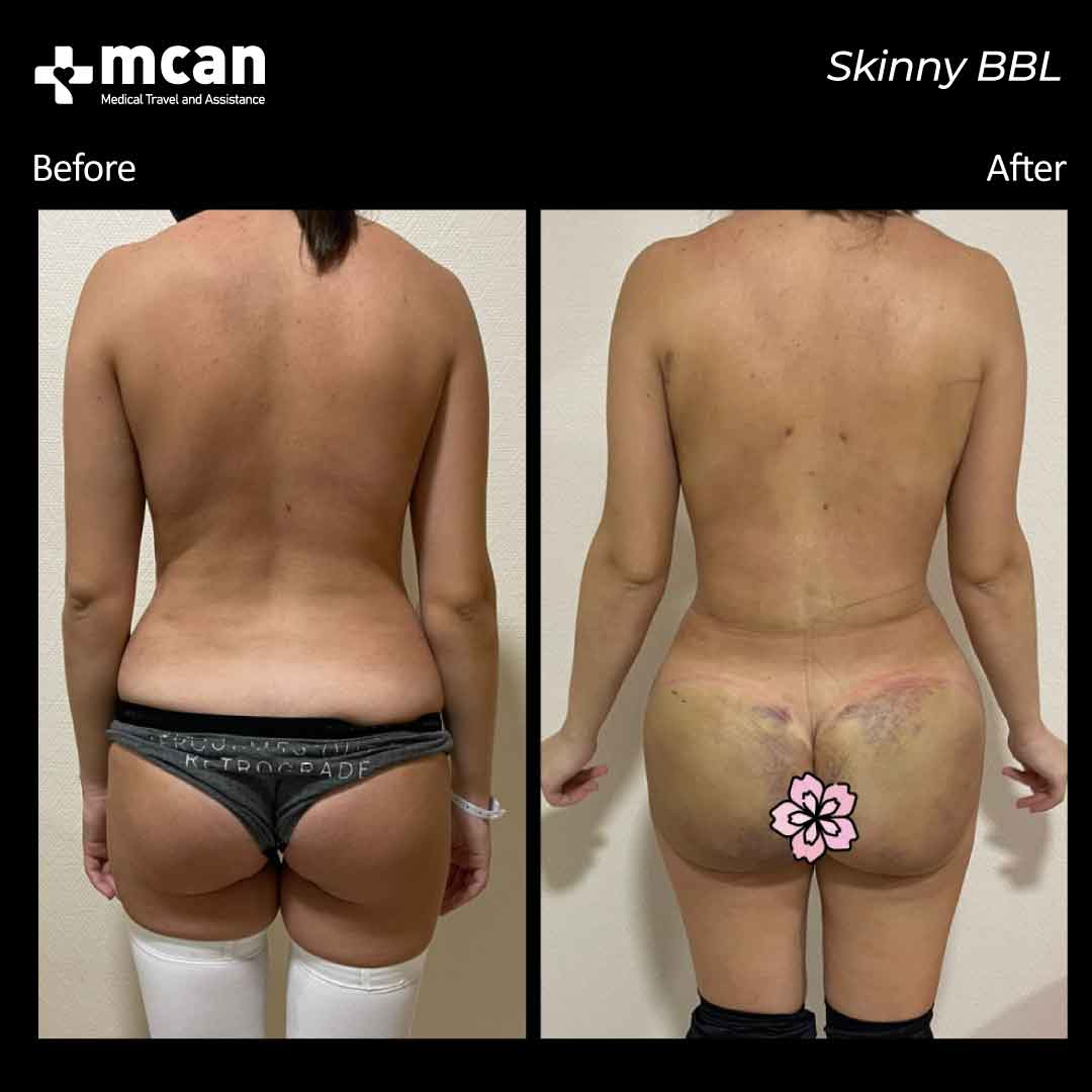 Skinny BBL Turkey Before After MCAN Health 02042101