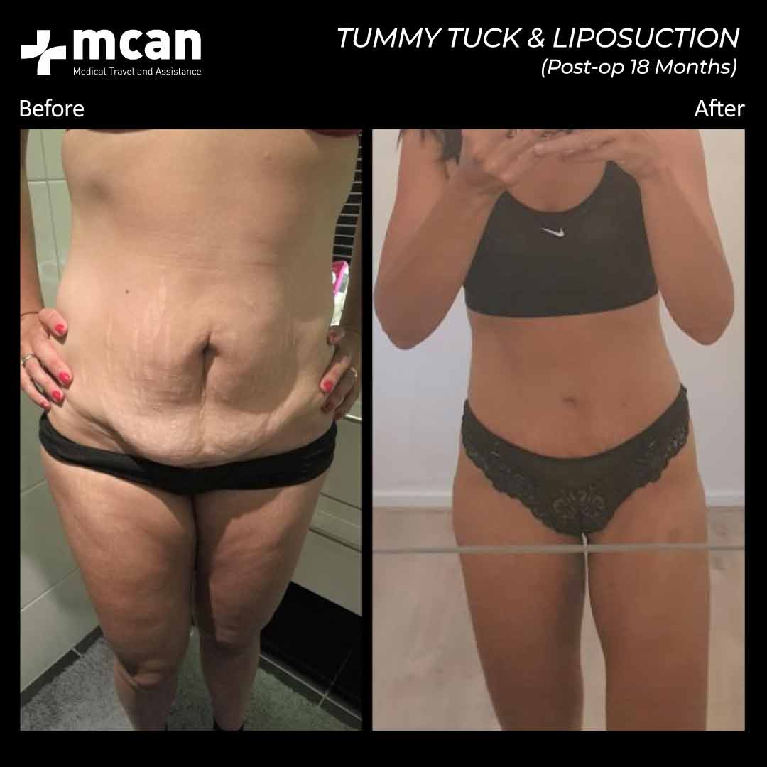 Tummy Tuck Liposuction Turkey Before After MCAN Health 02042101