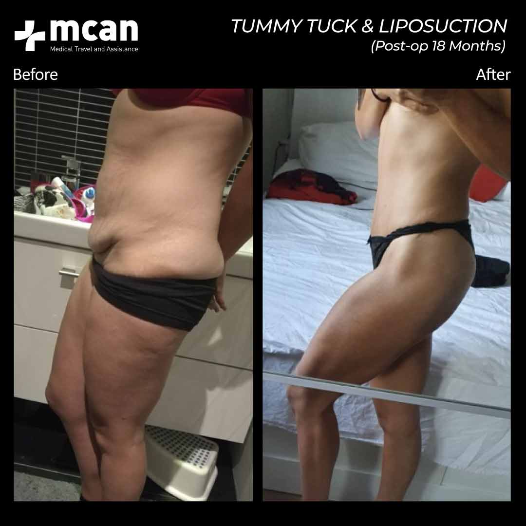 Tummy Tuck Liposuction Turkey Before After MCAN Health 02042102