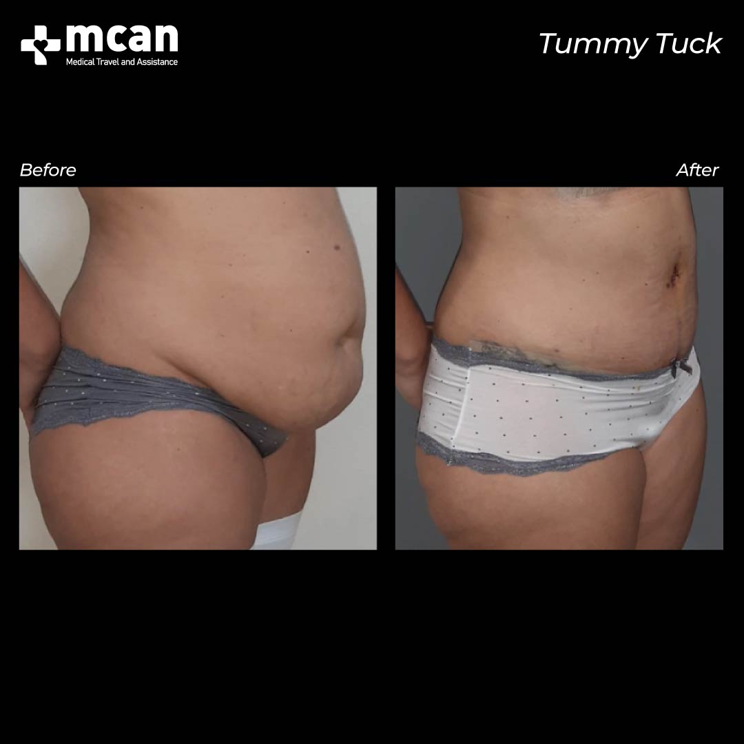 Tummy Tuck Turkey Before After 17022101