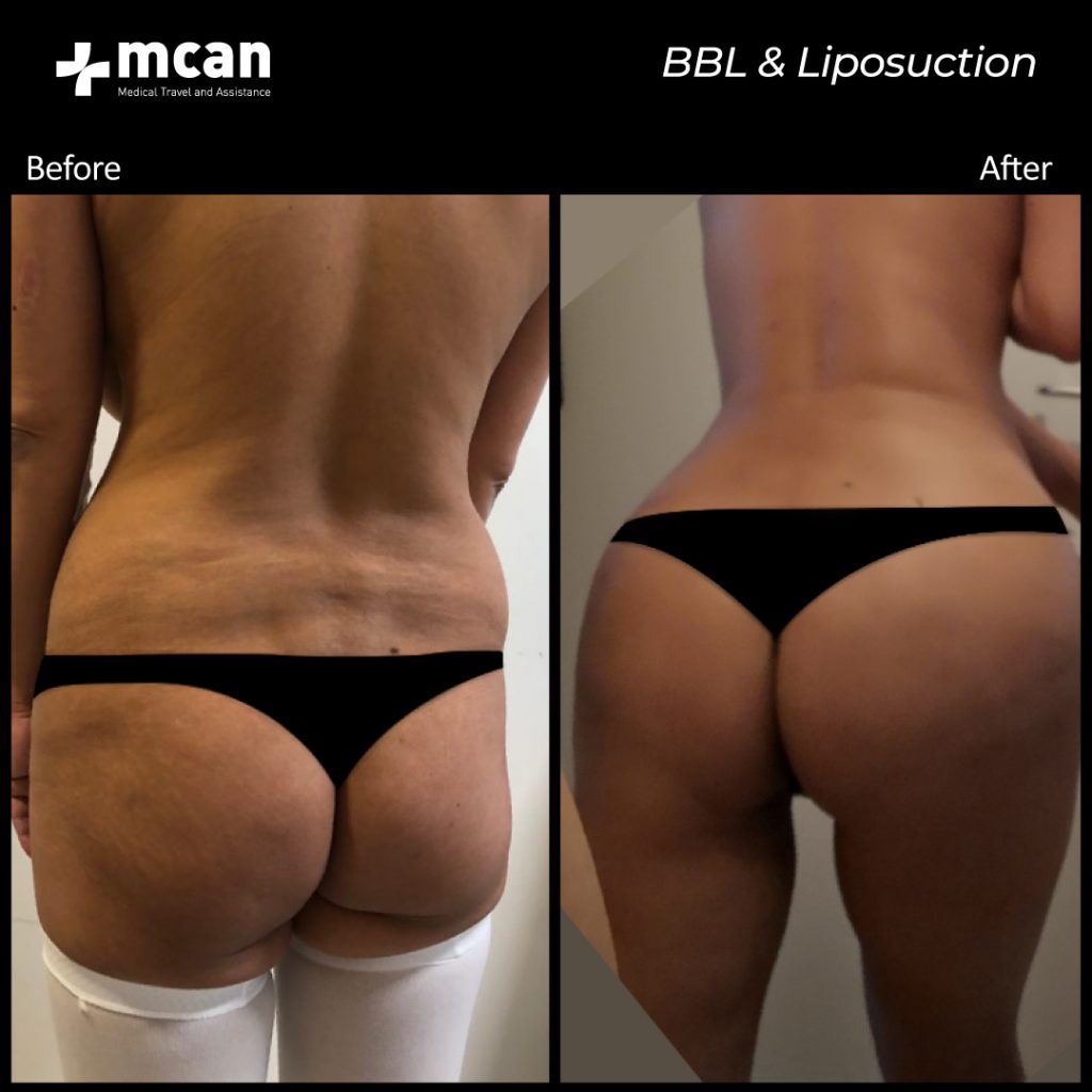 bbl liposuction 06.04.20