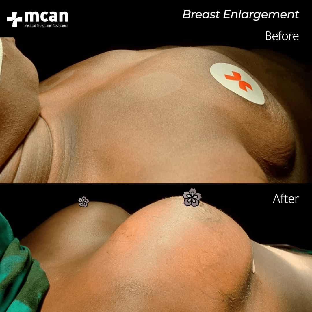 breast enlargement post