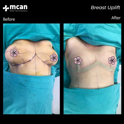 breast uplift turkey before after 01
