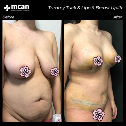 breast uplift turkey before after 04