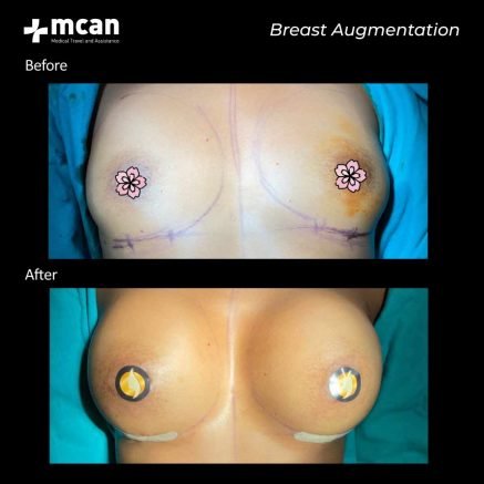breast uplift turkey before after 05