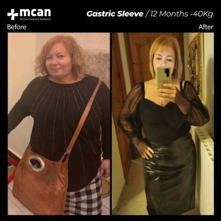 gastric sleeve turkey before after 03