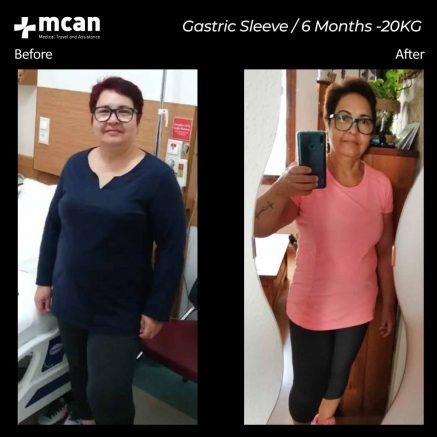gastric sleeve turkey before after 04