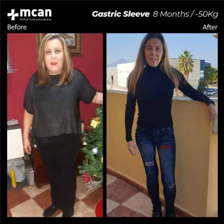 gastric sleeve turkey before after 07