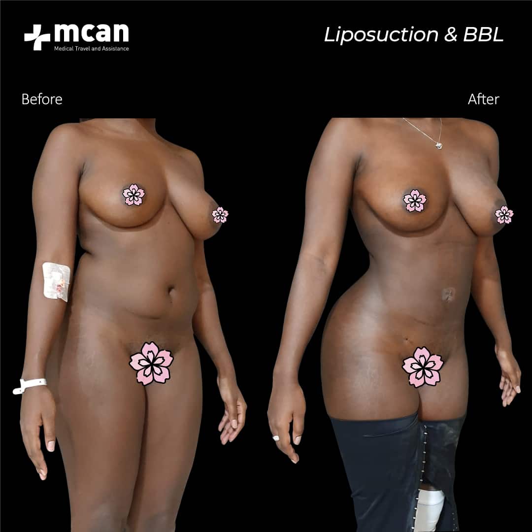 liposuction bbl