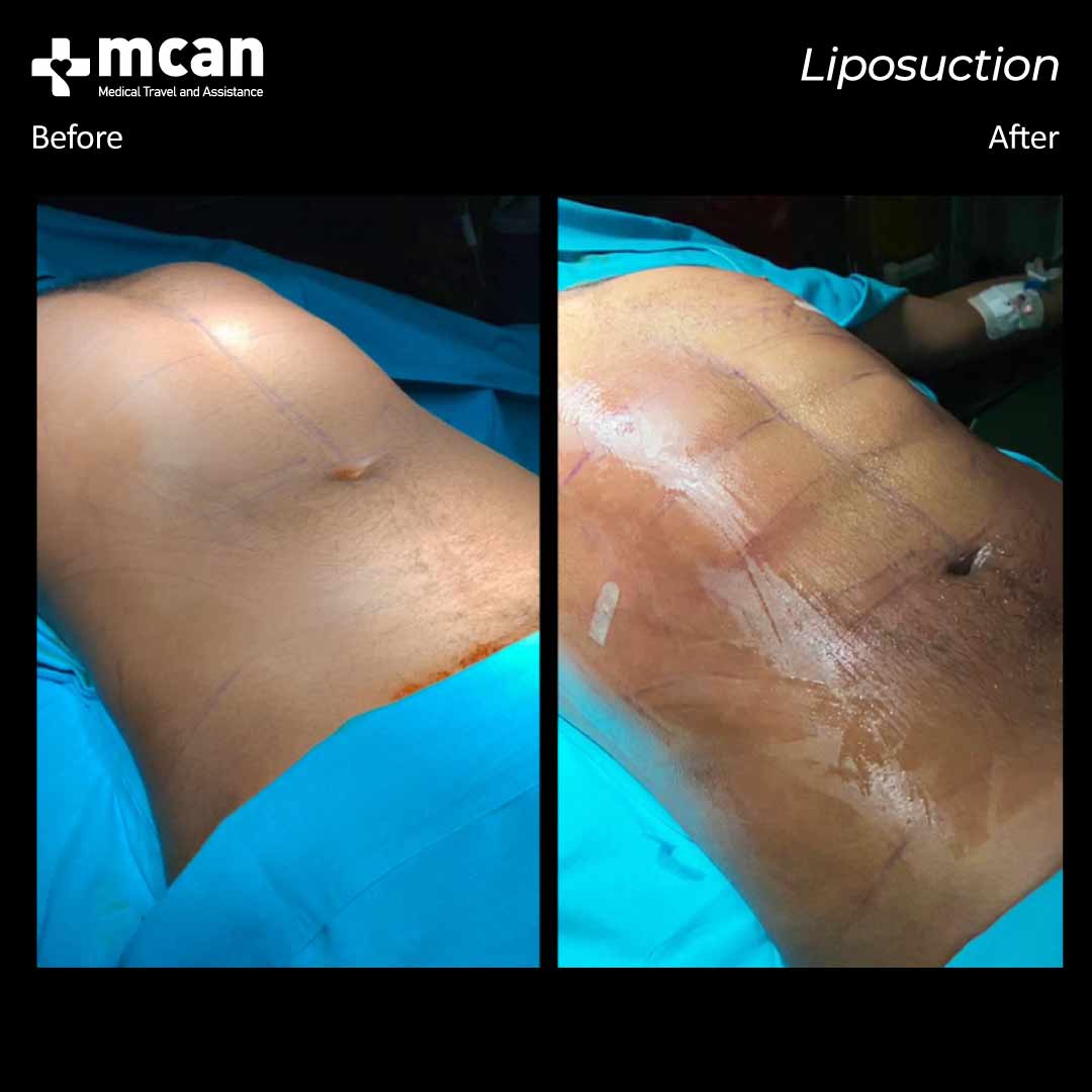 liposuction before after 25022101