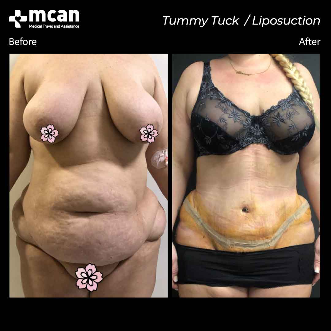 liposuction tummy tuck before after 25022101