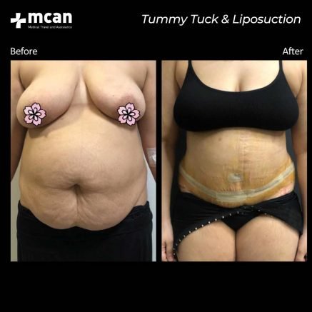 liposuction turkey before after 01