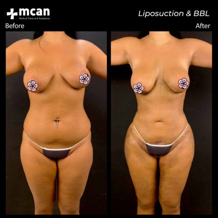liposuction turkey before after 02