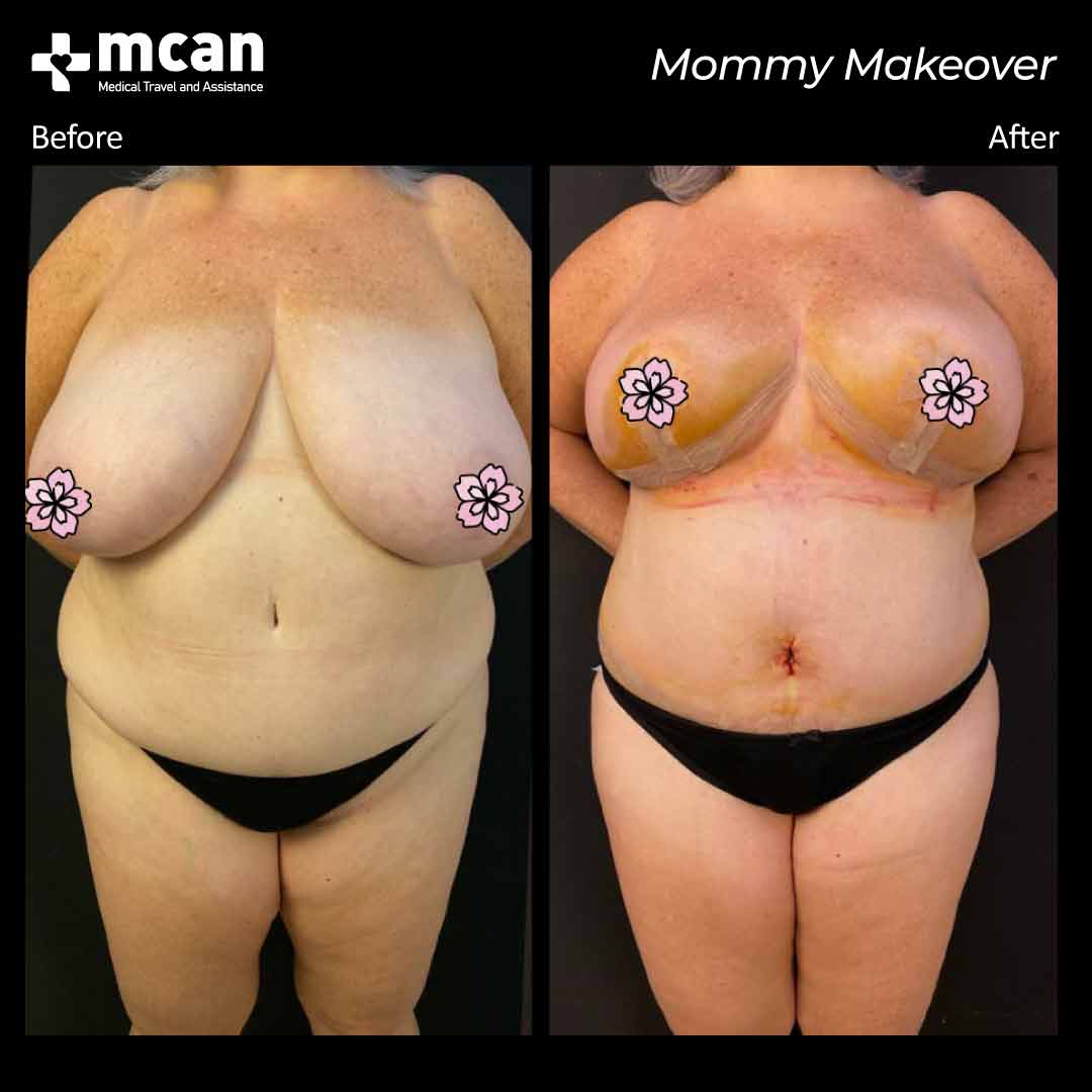 mommy makeover before after 25022101
