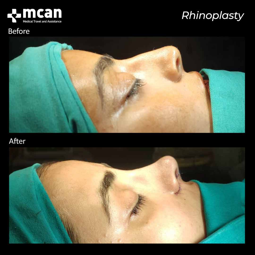 rhinoplasty before after 25022101