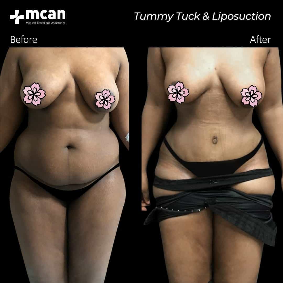 tummy tuck and liposuction