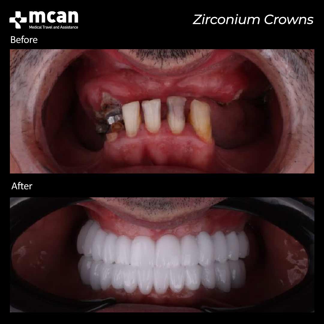 zirconium crowns before after 25022101