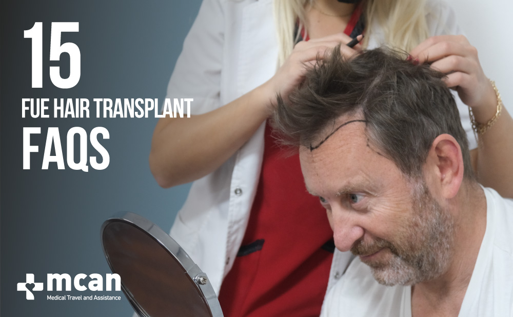 Important questions about FUE hair transplant