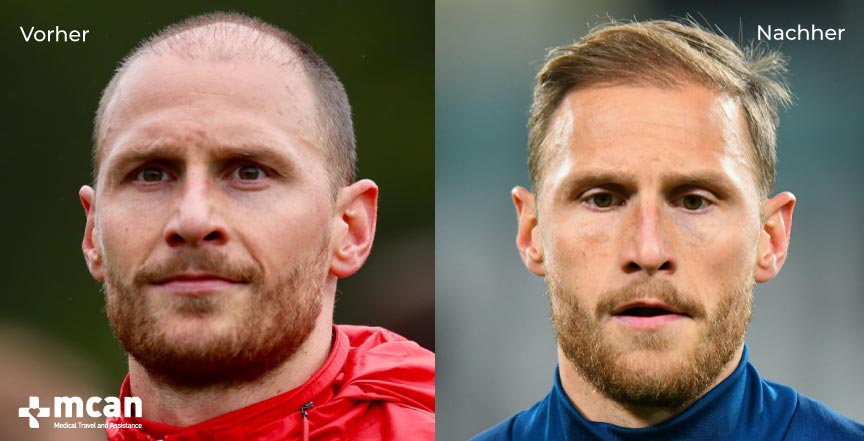 Benedict Höwedes Haartransplantation