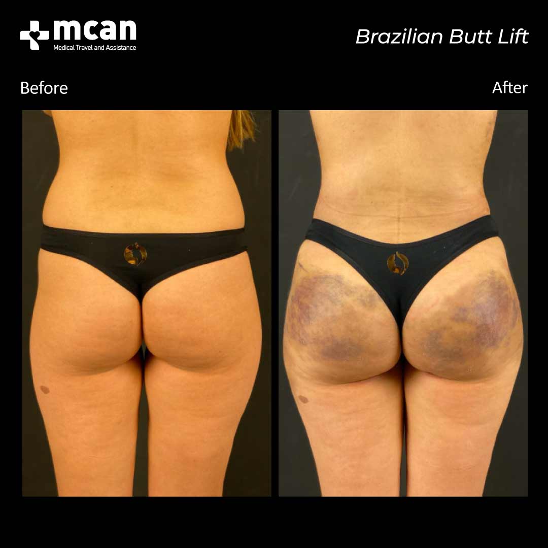 brazilian butt lift turkey before after 31032102