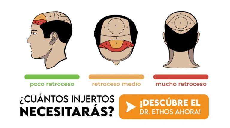 calculadora de injertos 1