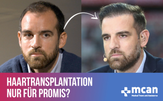 haartransplantation nur fuer promis