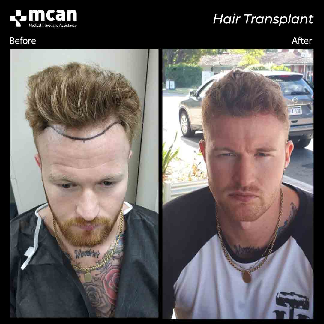 hair transplant turkey before after 15032101