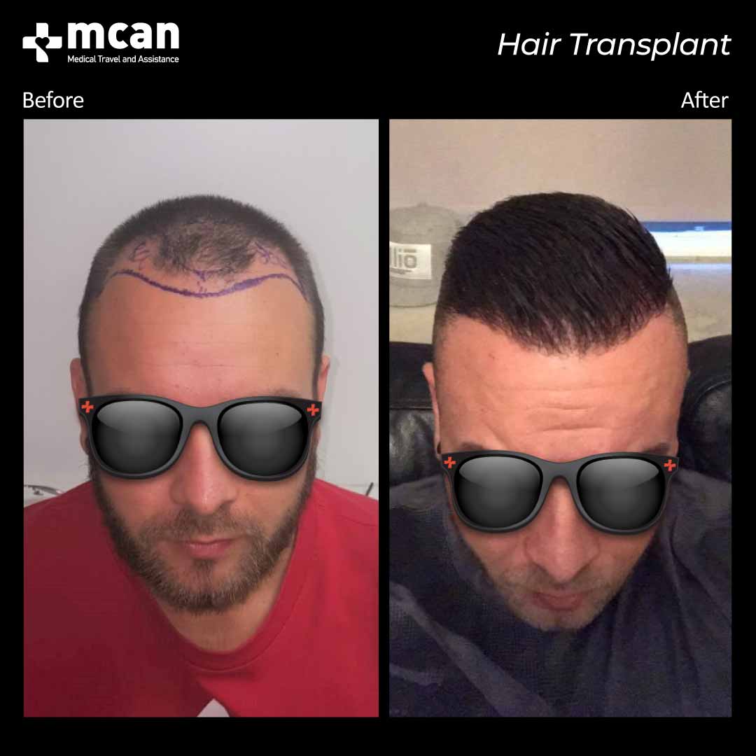 hair transplant turkey before after 150321010
