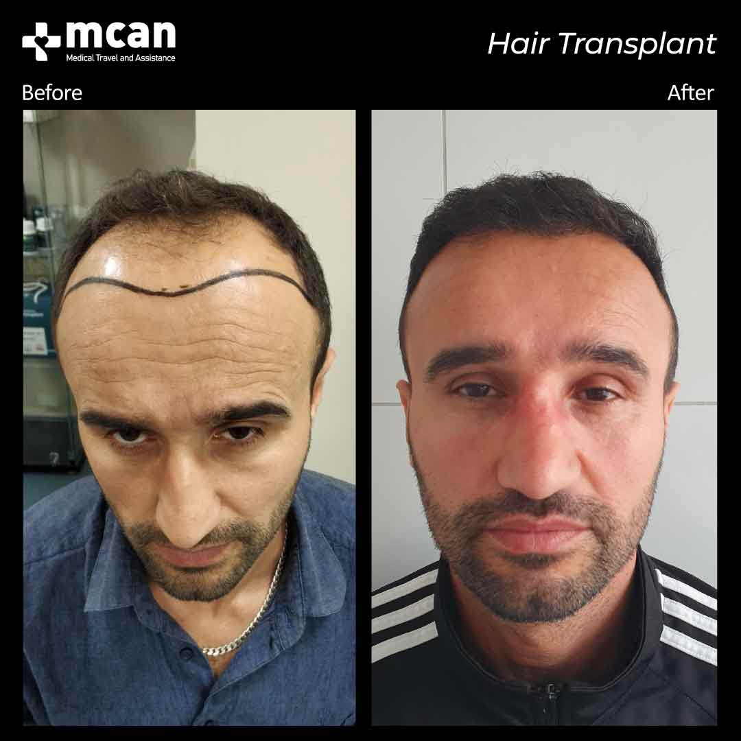 hair transplant turkey before after 150321011