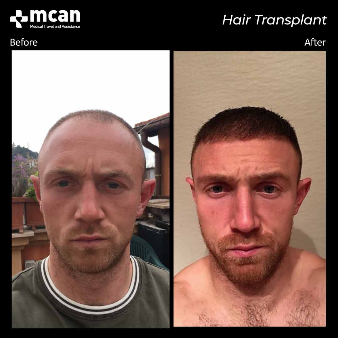 hair transplant turkey before after 150321013