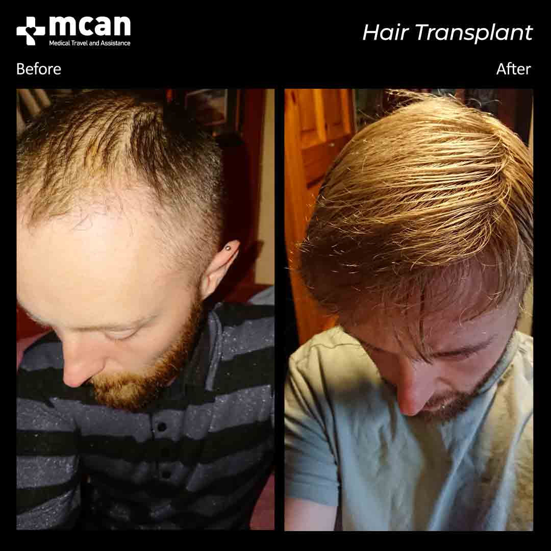 hair transplant turkey before after 150321014