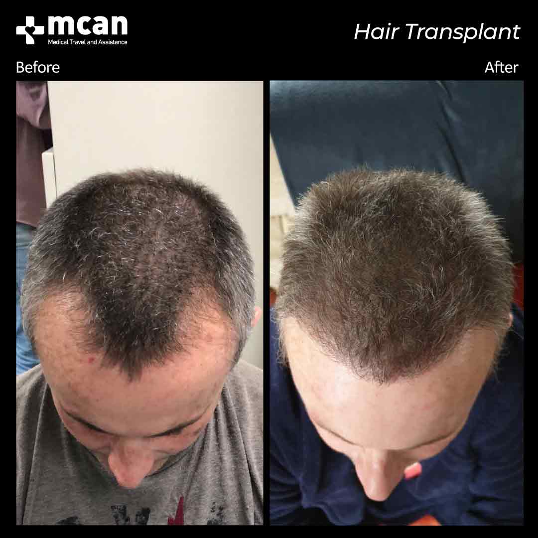 hair transplant turkey before after 150321015