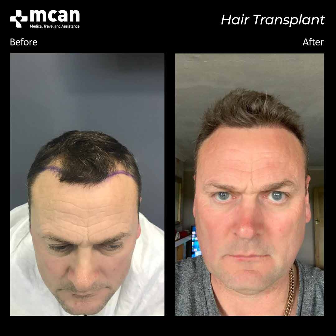 hair transplant turkey before after 150321016