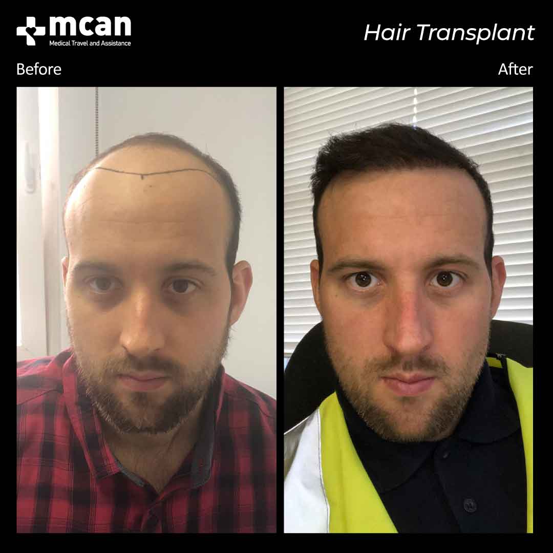 hair transplant turkey before after 150321017