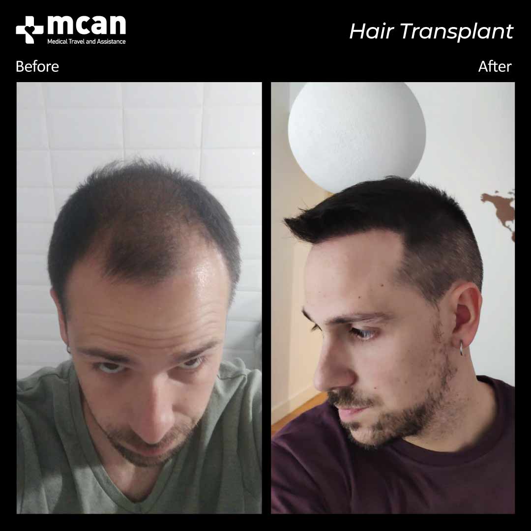 hair transplant turkey before after 150321018